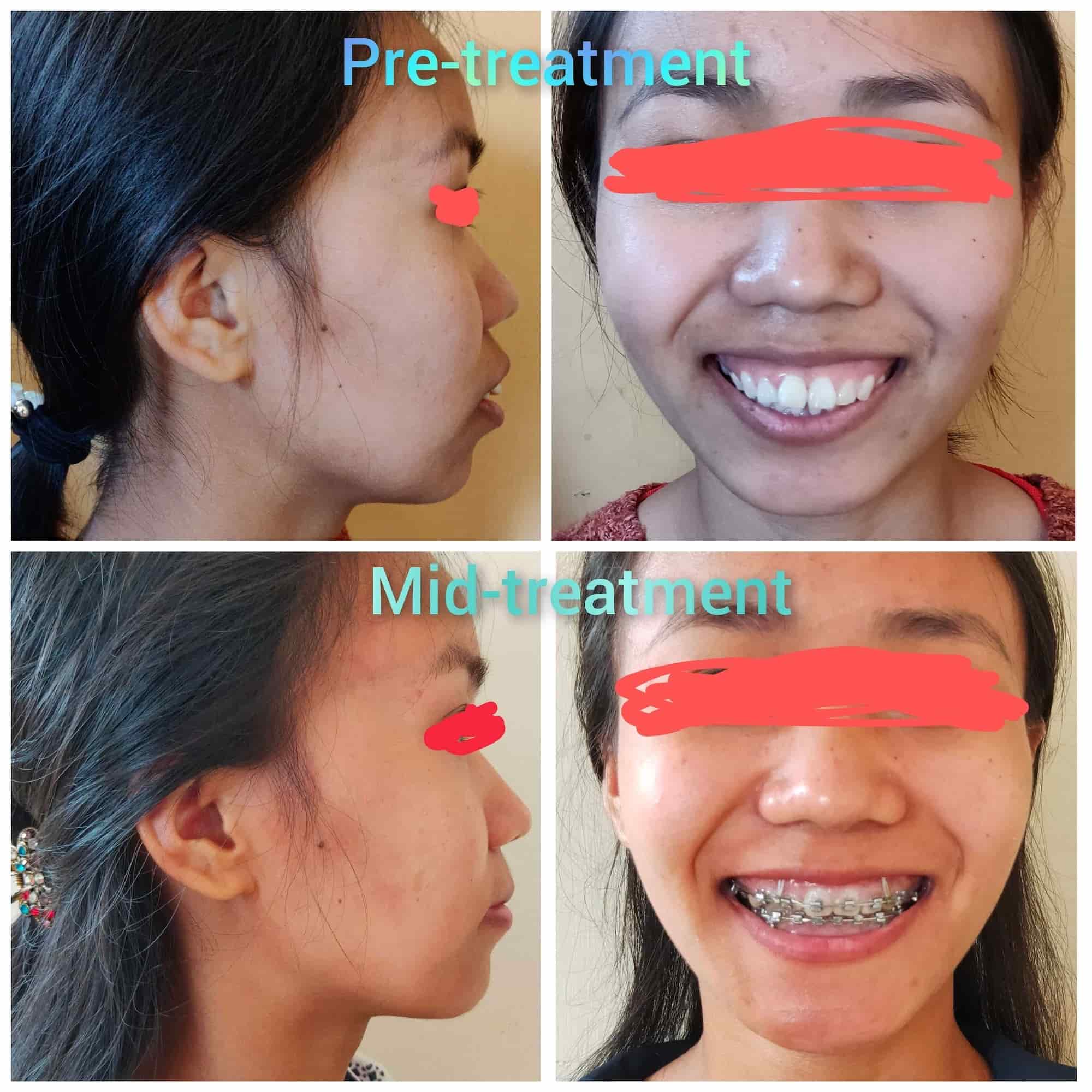 debabrata pal recommends braces facial comp pic