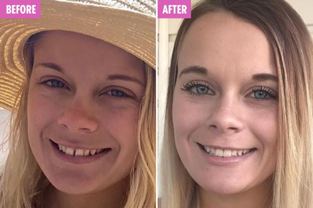 braces facial comp