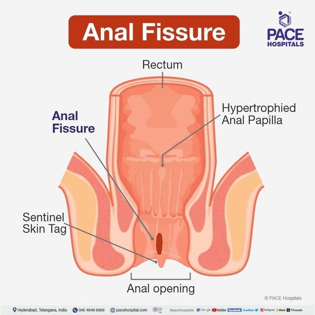 deedee morales like anal category photo chelsea cuaresma recommends anal category pic