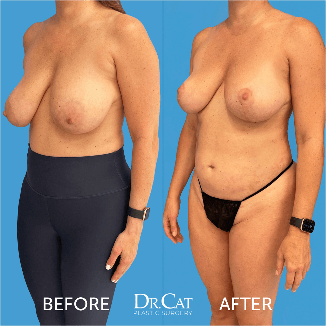 davis linda recommends Big Massive Saggy Tits