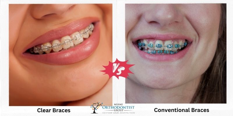 anik ani recommends braces facial comp pic
