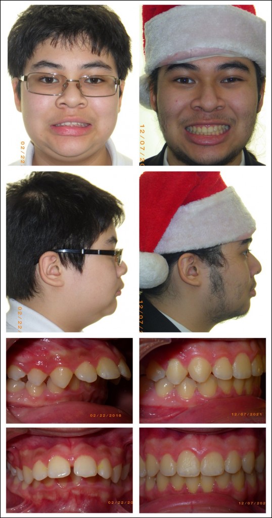 audrey fix recommends braces facial comp pic
