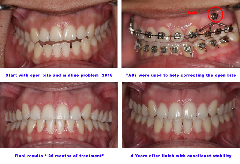 anand viswanathan share braces facial comp photos