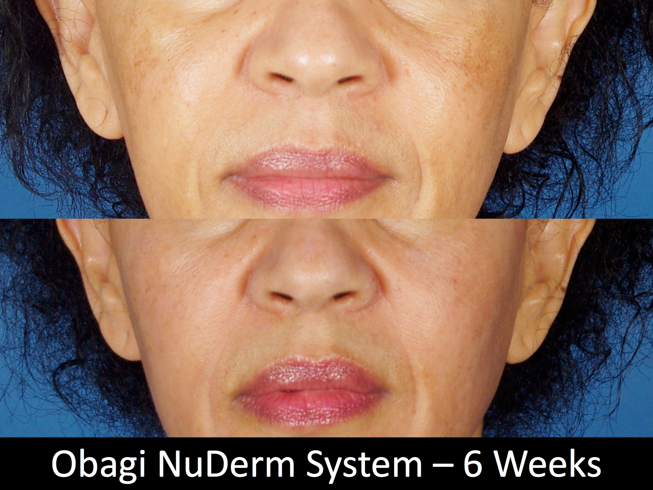 Nude Facial livry gargan antonio pabon recommends Nude Facial