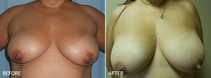 bearbear lee recommends Skinny Big Titties